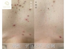 ココチ(KOKOCHI)/ハーブピーリング(デコルテ)