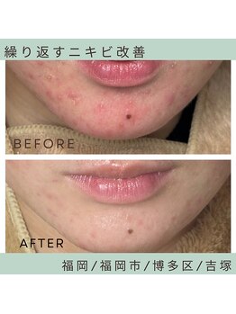 ソワ 吉塚店(soi)/昔からずっとニキビにお悩み。