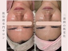 ファシネアオヤマ(FACINE AOYAMA)/乾燥による赤みの改善♪