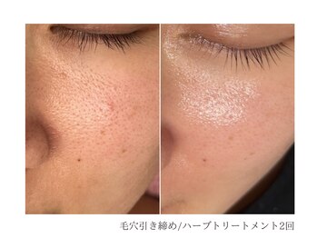 ルーム(room)/ハーブトリートメント2回