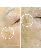 ブライズ(BRISE)/VOSスキンフェイシャル