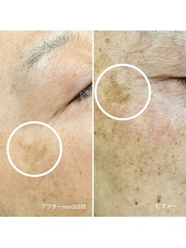 ブライズ(BRISE)/VOSスキンフェイシャル