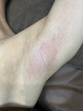 ユウユウ(YUYU)/艶の極み脱毛：Sパーツ