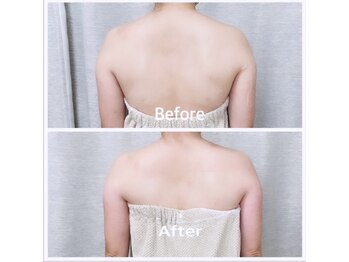 ボディーシェルター 横浜桜木町/肩の盛り上がりが気になる方