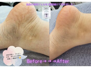 リリット/専用保湿ジェルが優しい！