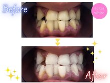 エクシアホワイトニング 天神店/ビフォーアフター　6カ月後