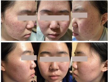 ナチュラ ソース(NatureSouce)の写真/【短期間で肌質改善を実感!!】毛穴洗浄付き肌トラブル改善コース★繰り返すニキビ/赤み/痒みの徹底鎮静ケア