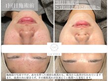 ラヴィオーラ 名駅(LaViora)/ダイヤモンドハーブピーリング