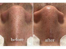 KMB 中崎町店/毛穴洗浄/モンロー式