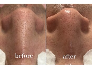 KMB 中崎町店/毛穴洗浄/モンロー式