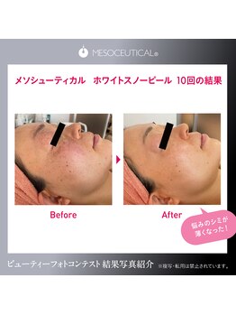 レアスキン(Rare skin.)/ホワイトスノーピール