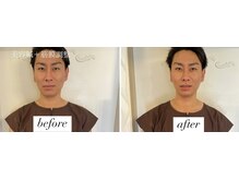 ヤマモト 表参道院(YAMAMOTO)/美容鍼＋筋膜調整　メンズ美容鍼
