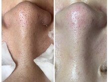 エヌエクラ(N.eclat.)/毛穴ごっそり洗浄