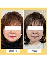 クローバー(clover)/【before/after】施術１回目翌日