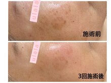 フェイシャルサロン うらら(ulala)の雰囲気（肌育【ハーブピーリング】は広範囲のシミや定着したくすみにも◎）