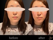 チョコバリ 恵比寿店(chocobari)/小顔リフトアップ（美容鍼）30代