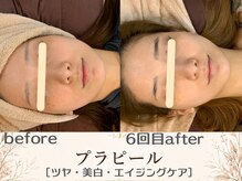 エスポワール(espoir)/初回before・６回目before