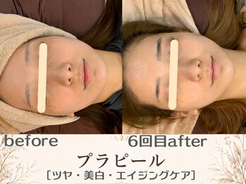 エスポワール(espoir)/初回before・6回目before