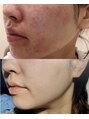 エービューティーサロン 松山店(A BEAUTY SALON.) 自身の長年肌荒れ経験を基に、悩みに寄り添うカウンセリングを。