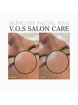 ルーナ(Runa)/根本的な【肌質・毛穴改善】