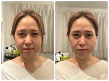 クランシュプール恵比寿鍼灸院/ビフォーアフター/1回の変化！