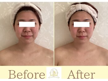 リコ(Rico)/エラの左右差もスッキリ整う