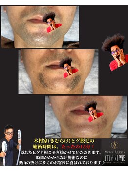キムラケ(KIMURAKE)/しぶとい髭も数回で!