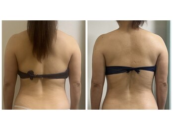 ピンクマジック(PINKMAGIC)/痩身コース（５回コースご利用）