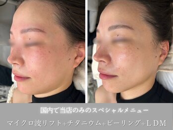 イロハ(IROHA)の写真/次世代最強小顔施術*マイクロ波リフト導入サロン◆二重顎/たるみ/もたつきに!脂肪減少・効果を即実感