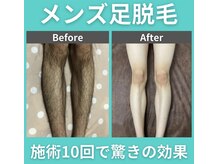 男性特有の濃い体毛・毛量のお悩みも細やかにご対応可能