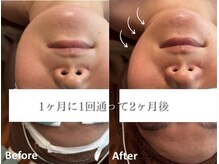 ココスターリー(Coco starry)/1ヶ月に1回来店、2ヶ月後の様子