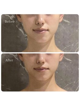 インディバ 六本木/【全顔/首肩/デコルテ】