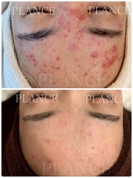プランス 恵比寿店(PLANCE)/おでこのニキビケア