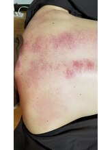 サヤパドマ(sayaPadoma)/スライドカッピングの跡