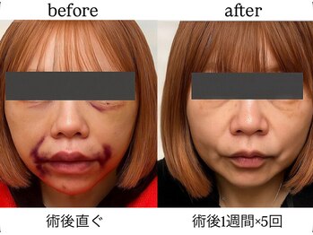 術後インディバ専門サロン 新宿/切開リフト/輪郭3点/インディバ