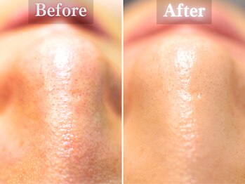 ボーンオム(Born Homme)/毛穴洗浄＋美容液導入：20代男性