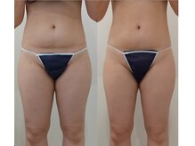 クレール アオヤマ(CLAIRE AOYAMA)/お腹引き締め太ももサイズダウン