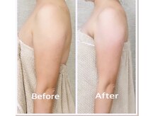 ボディーシェルター 横浜桜木町/二の腕の余計なお肉をスッキリ！