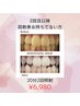 【2回目以降回数券お持ちでない方】ホワイトニング単発¥6980