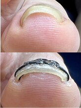 ひかわ整骨院 熊本巻き爪センター&nbsp;巻き爪矯正 施術前後