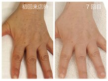 キレイテ 福岡天神店/50代/7回目【天神ハンドケア】