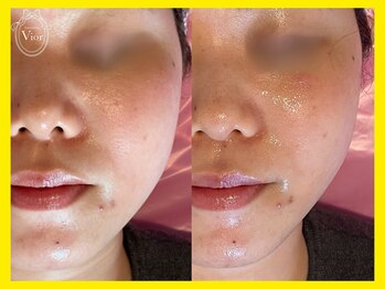 ハーブピーリング 名古屋/頬スッキリ！シャープな印象へ♪