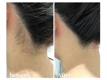 セルフ脱毛サロン　SELFMADE イオンタウン仙台泉大沢店【3/29 NEW OPEN（予定）】 /【ビフォーアフター】セルフ脱毛