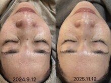 ビーマジック(Be Magic)/毛穴洗浄/小顔/ビフォーアフター