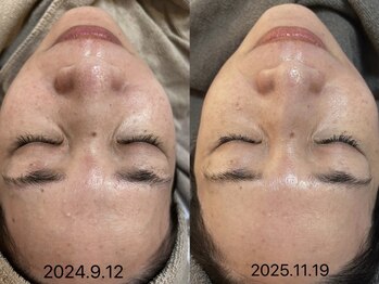 ビーマジック(Be Magic)/毛穴洗浄/小顔/ビフォーアフター