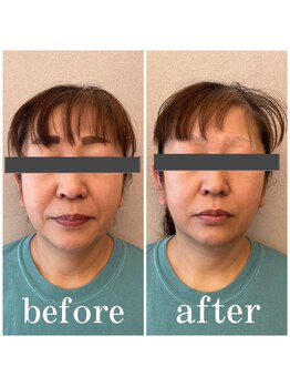 ディス イズ ミー エステティック(This is Me Aesthetic)/劇的リフトアップ