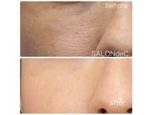 3か月で肌質革命![小顔/シミ/シワ/ほうれい線/たるみ/毛穴ケア］