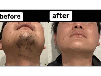 ゴッド(GOD)/ヒゲ脱毛