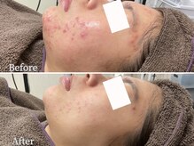 ニキビケア研究所 横浜店/跡にならないニキビケア