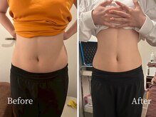 【depolo脂肪分解】で短期間集中ケア◇ダウンタイムなしです！